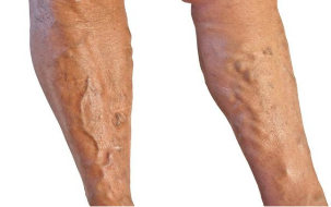 Traitement des varices dans les jambes