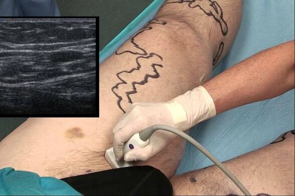diagnostic des varices chez les hommes