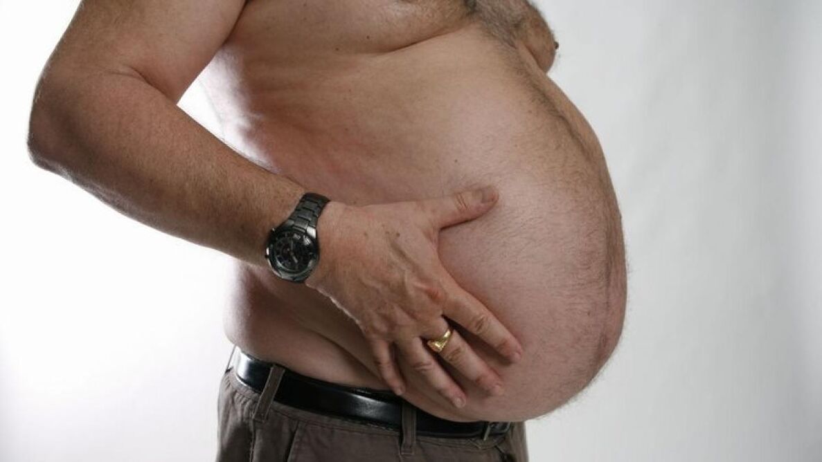 l'obésité comme cause du développement des varices