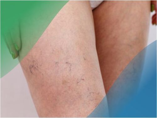 Le réseau vasculaire sur les jambes est l'un des symptômes des varices