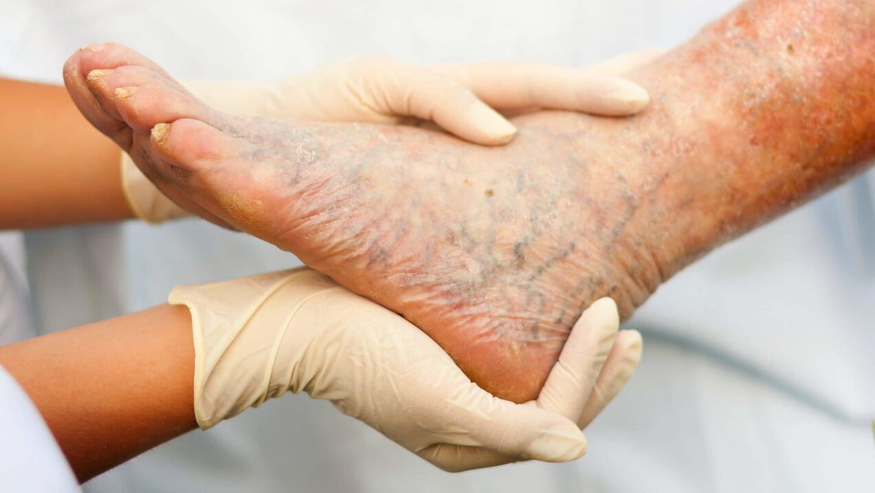 Le phlébologue s'occupe du traitement des varices des jambes