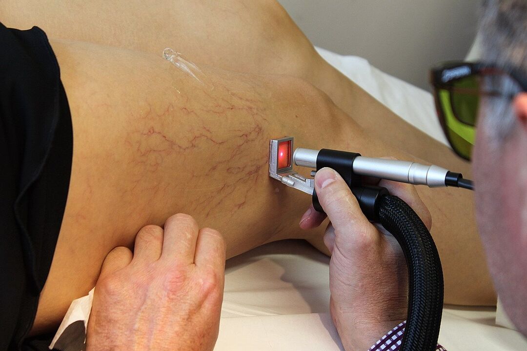 Coagulation laser