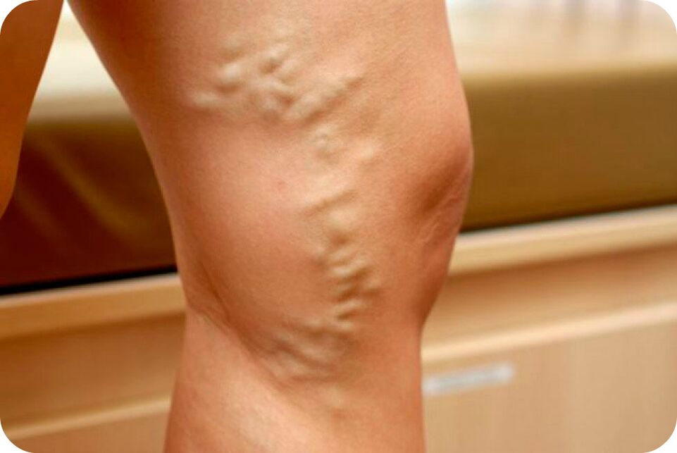 Varices des veines