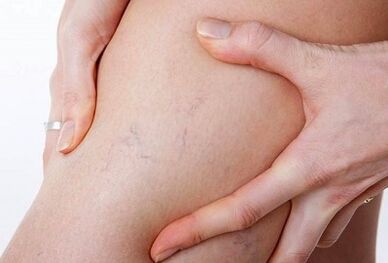 Actions interdites pour les varices