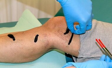Hirudothérapie pour les varices