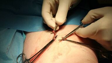 Flebectomie pour les varices