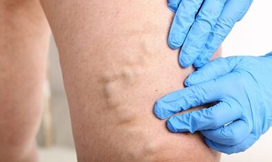 Varices sur les jambes