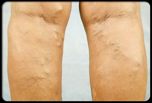 Varices sur les jambes