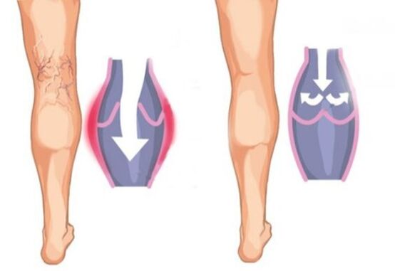 à quoi ressemblent les varices